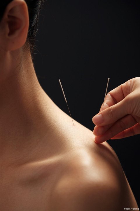Thin needles in a person's shoulder